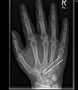 broken bones hand